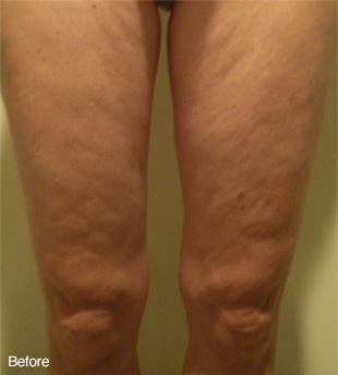 Red Light Therapy Before Female