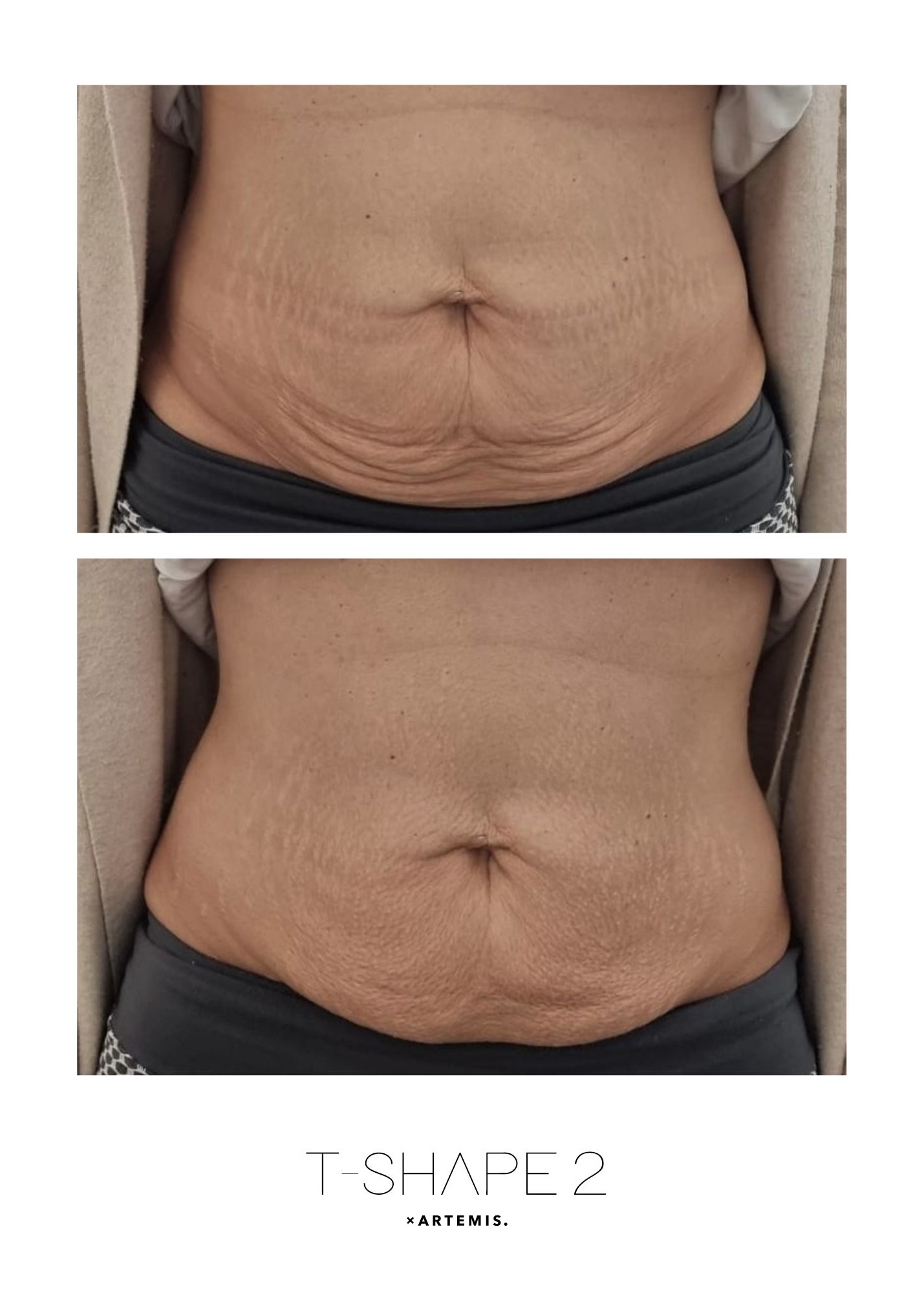 How T Shape 2 Supports Medical Weight Loss