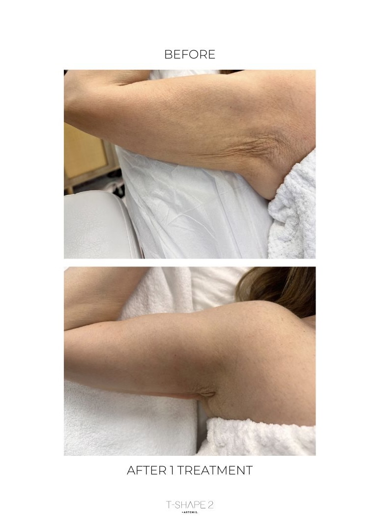 Is T-Shape 2 Right for You?